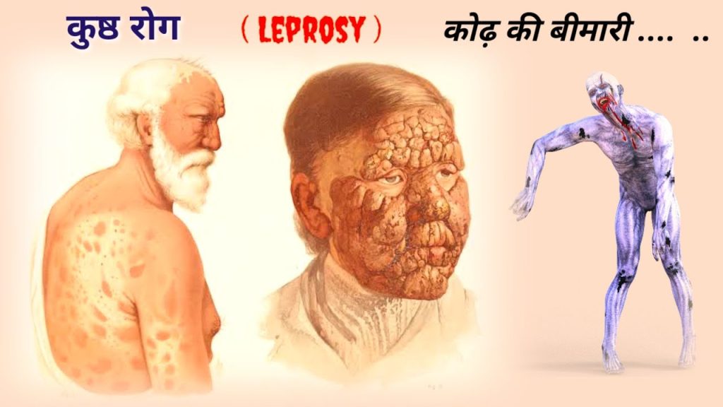 कोढ़, कुष्ठ रोग (Leprosy) के लक्षण