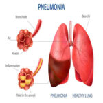 निमोनिया क्या है? लक्षण, बचाव और उपचार (What is Pneumonia? Symptoms, Prevention and Treatment in Hindi)