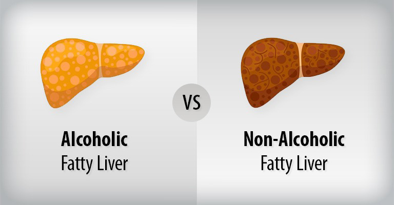 Types of Fatty Liver