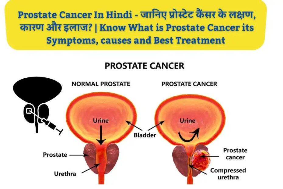 प्रोस्टेट कैंसर (Prostate Cancer): लक्षण, कारण और उपचार (Prostate Cancer: Symptoms, Causes and 2 important Types of Treatment in Hindi)
