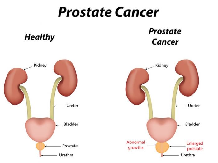 Abnormal Growth Prostate 