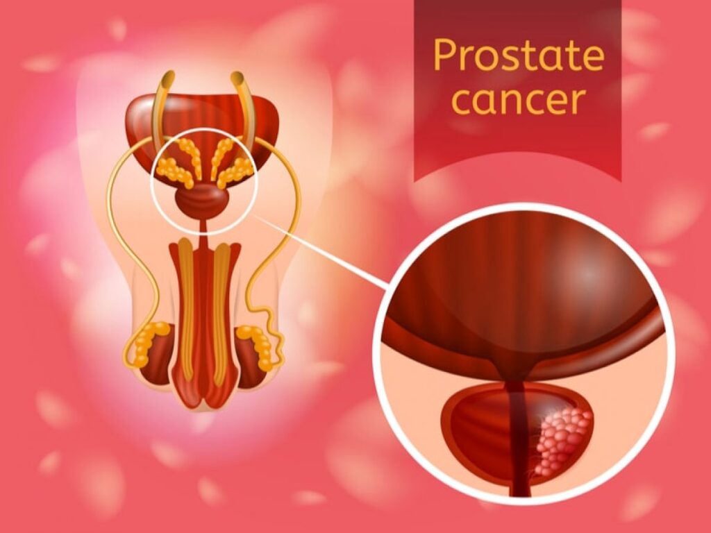 प्रोस्टेट कैंसर (Prostate Cancer)