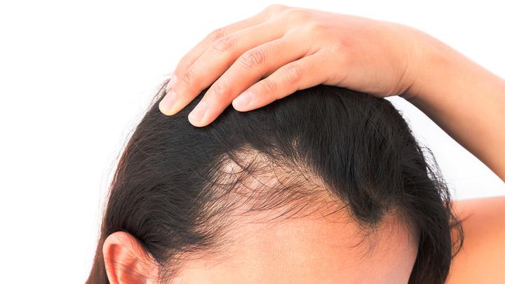 ट्रैक्शन एलोपेसिया (Traction Alopecia)