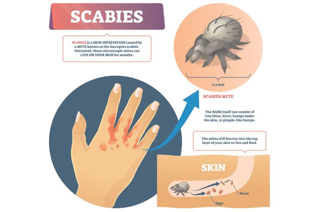 What is Scabies?