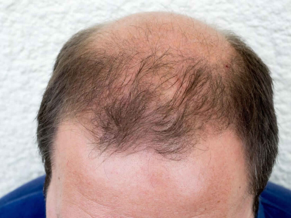एंड्रोजेनिक एलोपेसिया (Androgenic Alopecia)