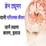 ब्रेन ट्यूमर: कारण, लक्षण और उपचार के विकल्प (Brain Tumor: Causes, Symptoms, and Treatment Options in Hindi)