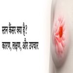 स्तन कैंसर: लक्षण, उपचार, और रोकथाम! (Breast Cancer: Symptoms, Treatment, and Prevention in Hindi)