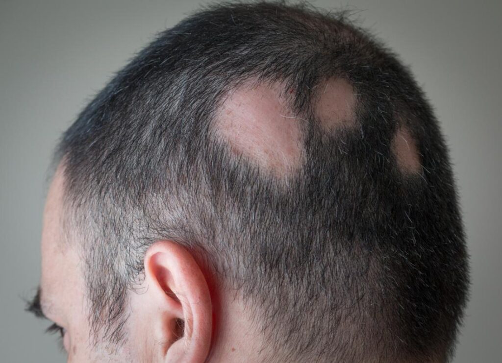 एलोपेशिया एरियाटा (Alopecia Areata)
