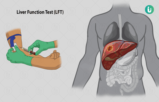 लिवर फंक्शन टेस्ट (Liver Function Test) (LFT)