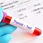 TSH Test (Thyroid Test ) क्या है, और इसको क्यों कराया जाता है? (What is TSH Test (Thyroid Test), and why is it done in Hindi?)
