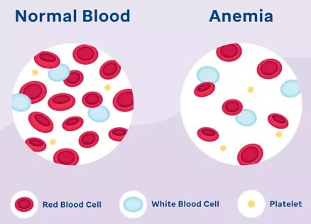 खून की कमी (Anemia)