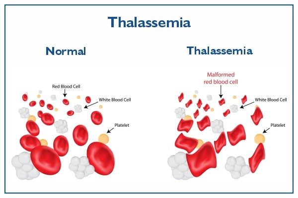 थैलेसीमिया (Thalassemia)